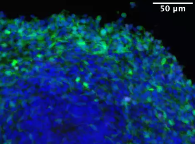 Gehirnorganoid das synthetischen Glukokortikoiden ausgesetzt wurde Ein Gehirnorganoid, das synthetischen Glukokortikoiden ausgesetzt wurde. Viele hemmende Neuronen (in Grün) sind sichtbar.