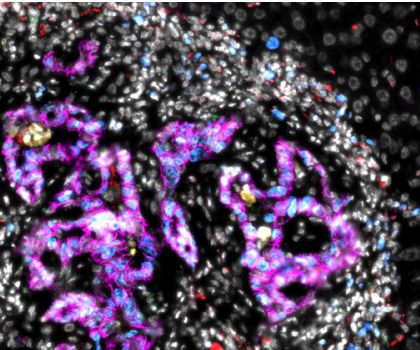 Darmkrebs-Metastase in der Leber Darmkrebs-Metastase in der Leber, mikroskopische Aufnahme. In Magenta: Darmkrebszellen, weiß: andere Zellen innerhalb der Metastase.
