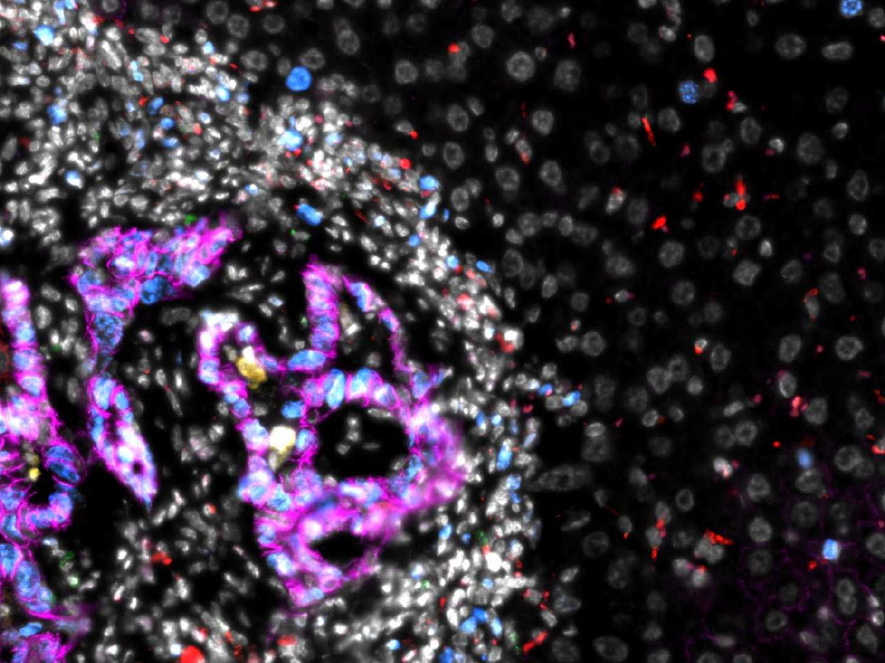 Darmkrebs-Metastase in der Leber, mikroskopische Aufnahme. In Magenta: Darmkrebszellen, weiß: andere Zellen innerhalb der Metastase.