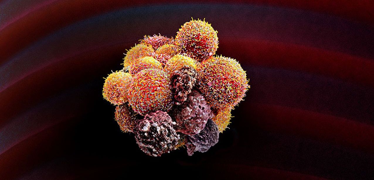 Neuer Therapieansatz bei Brustkrebs Herzmedikament Digoxin reduziert Metastasenrisiko Ein Wirkstoff aus dem Fingerhut kann solche im Blut zirkulierenden Klumpen aus Krebszellen auflösen und damit der Metastasenbildung vorbeugen.