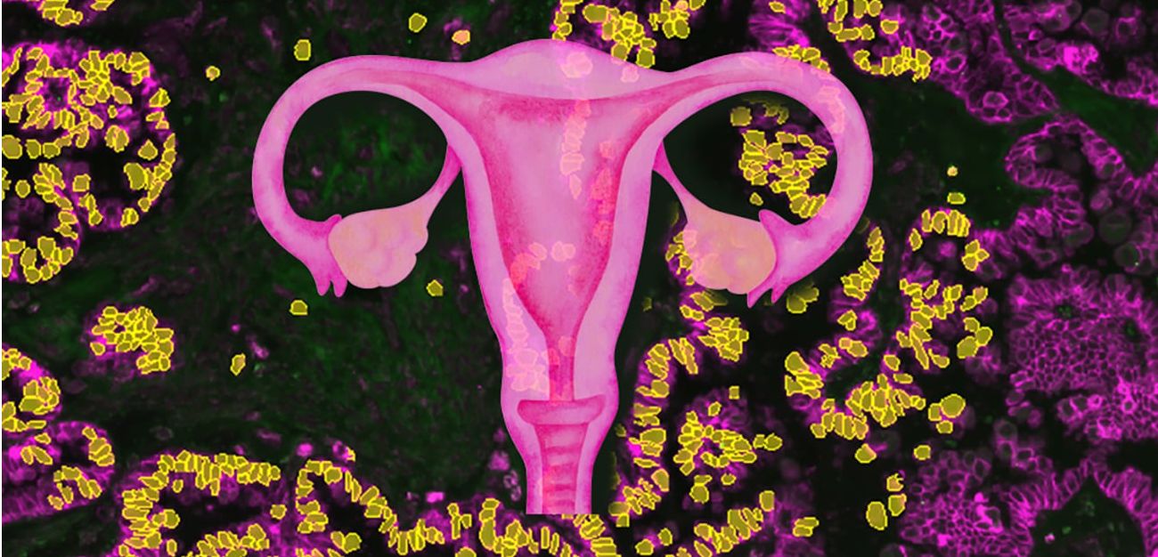 Gewebeschnitt eines serösen Borderline Tumors. In diesem mikroskopischen Bild sind die Zellen mittels Immuno-Fluoreszenz gefärbt. Einzelne Zellen des Tumors können mittels künstlicher Intelligenz erkannt werden (gelb).