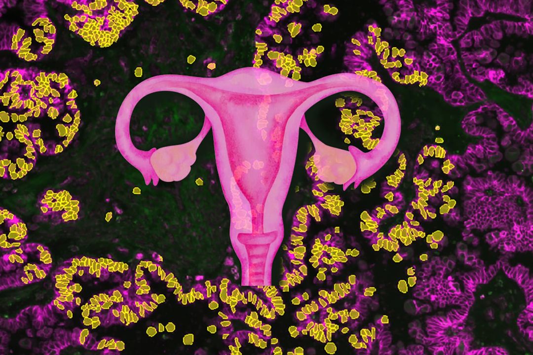 Gewebeschnitt eines serösen Borderline Tumors. In diesem mikroskopischen Bild sind die Zellen mittels Immuno-Fluoreszenz gefärbt. Einzelne Zellen des Tumors können mittels künstlicher Intelligenz erkannt werden (gelb).