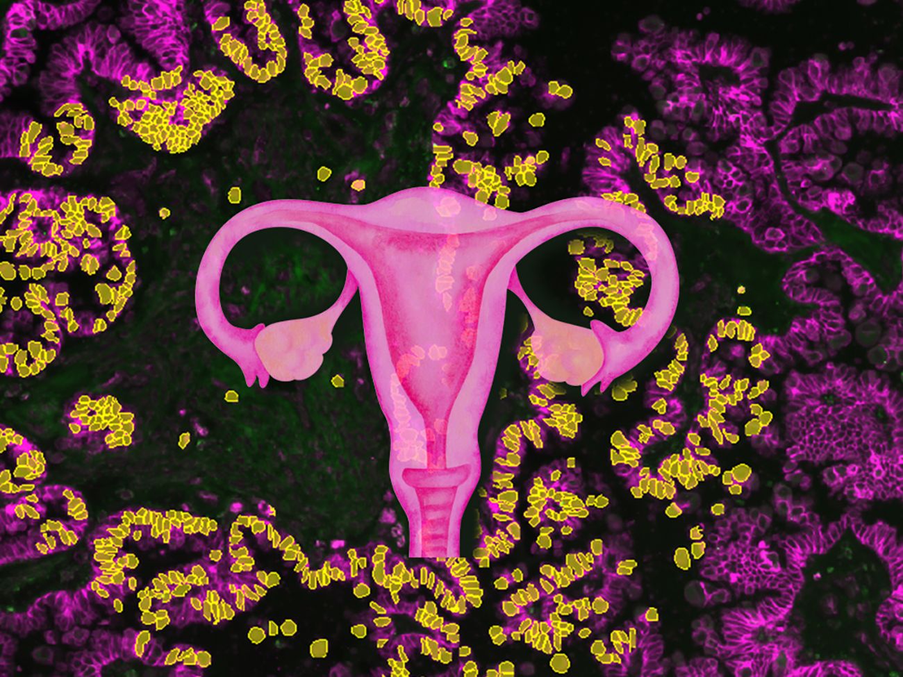 Warum Tumore invasiv werden: Neue Erkenntnisse aus der Forschung zu Eierstockkrebs Gewebeschnitt eines serösen Borderline Tumors. In diesem mikroskopischen Bild sind die Zellen mittels Immuno-Fluoreszenz gefärbt. Einzelne Zellen des Tumors können mittels künstlicher Intelligenz erkannt werden (gelb).