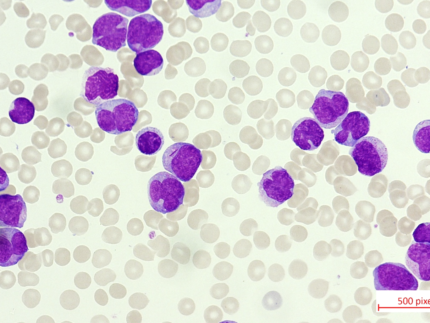 Leukämiezellen einer akuten myeloischen Leukämie (AML) im Blut Leukämiezellen einer akuten myeloischen Leukämie (AML) im Blut