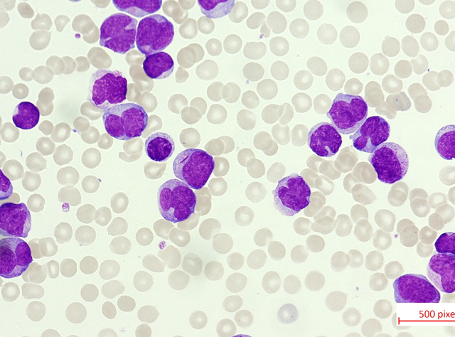 Leukämiezellen einer akuten myeloischen Leukämie (AML) im Blut Leukämiezellen einer akuten myeloischen Leukämie (AML) im Blut