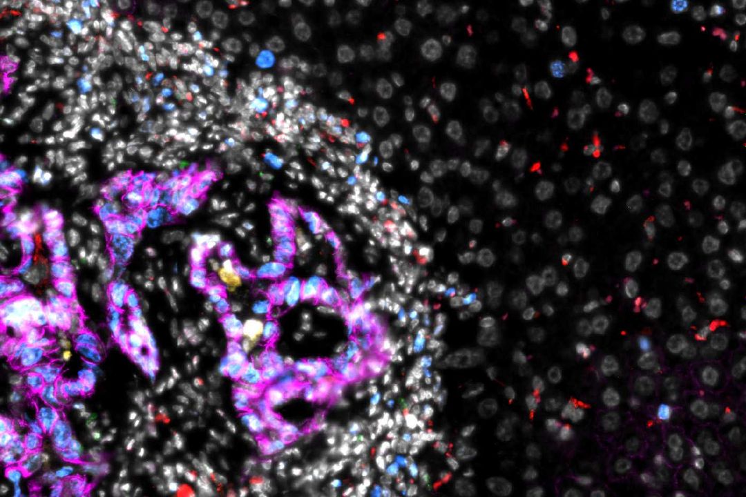 Darmkrebs-Metastase in der Leber, mikroskopische Aufnahme. In Magenta: Darmkrebszellen, weiß: andere Zellen innerhalb der Metastase.