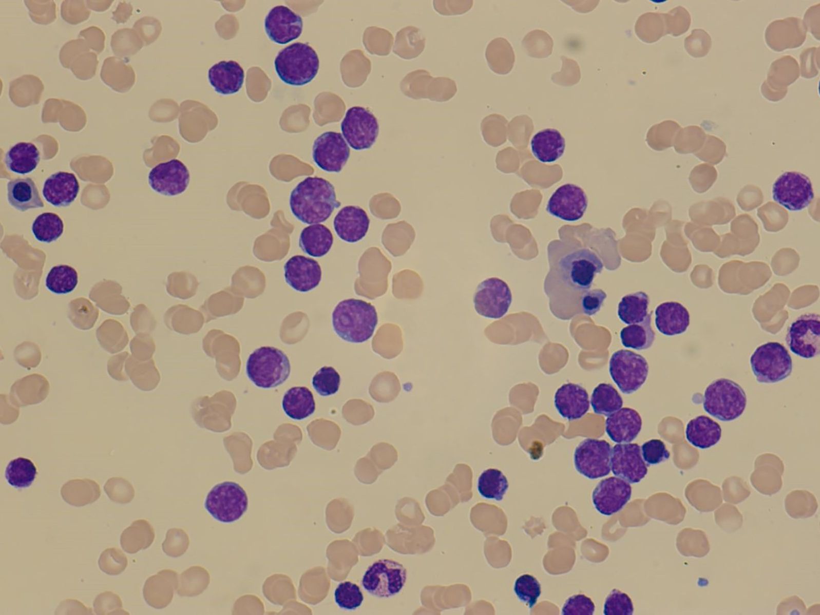 Bioinformatik-Tool: Molekulare Diagnostik der akuten lymphoblastischen Leukämie lymphatische Vorläuferzellen (ALL-Blasten)