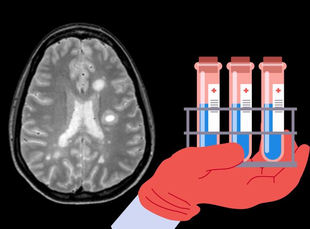Für die Diagnose von Multiple Sklerose ist neben der Bildgebung die Laboranalytik wichtig. Aufnahme Gehirn und Laborröhrchen, Darstellung für Artikel: Massenspektrometrie identifiziert neue MS-Biomarker: 5000 Liquorproben proteomisch analysiert