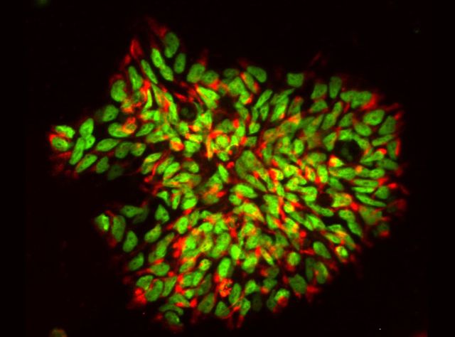 Multiple Sklerose: Humane induzierte neurale Stammzellen, die aus Hautzellen reprogrammmiert wurden. Humane induzierte neurale Stammzellen, die aus Hautzellen reprogrammmiert wurden.