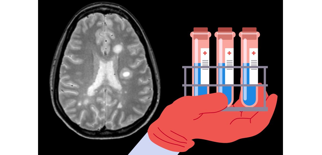 Für die Diagnose von Multiple Sklerose ist neben der Bildgebung die Laboranalytik wichtig. Aufnahme Gehirn und Laborröhrchen, Darstellung für Artikel: Massenspektrometrie identifiziert neue MS-Biomarker: 5000 Liquorproben proteomisch analysiert
