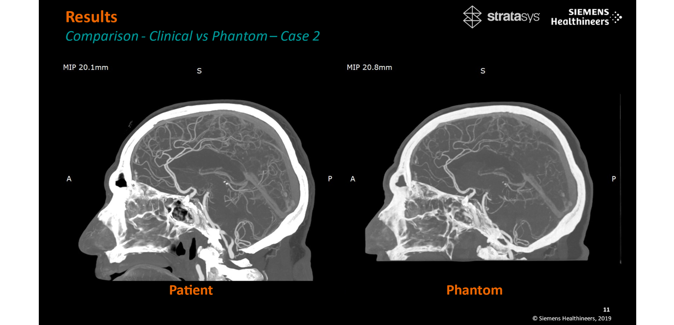 Stratasys and Siemens Healthineers: New findings on the quality of anatomical 3D prints