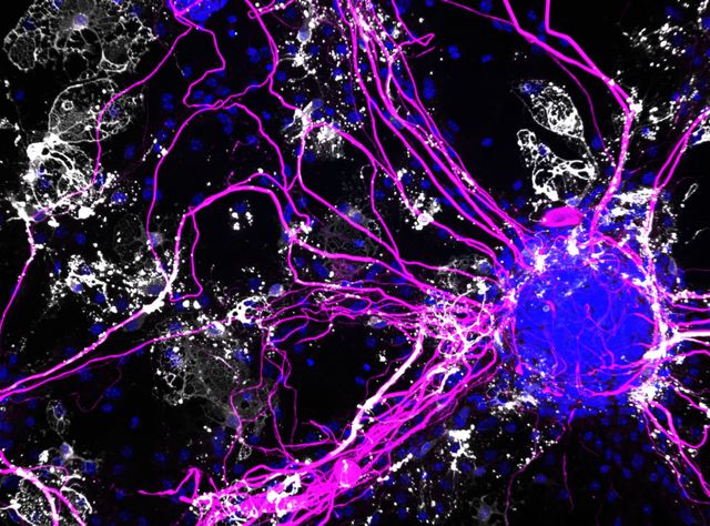 Co-Kulturen bestehend aus Neuronen, die Nervenfasern ausbilden und Oligodendrozyten, die diese Nervenfasern mit Myelin ummanteln. Co-Kulturen bestehend aus Neuronen, die Nervenfasern (pink) ausbilden und Oligodendrozyten, die diese Nervenfasern mit Myelin (weiß) ummanteln. Die Zellkerne sind blau angefärbt.