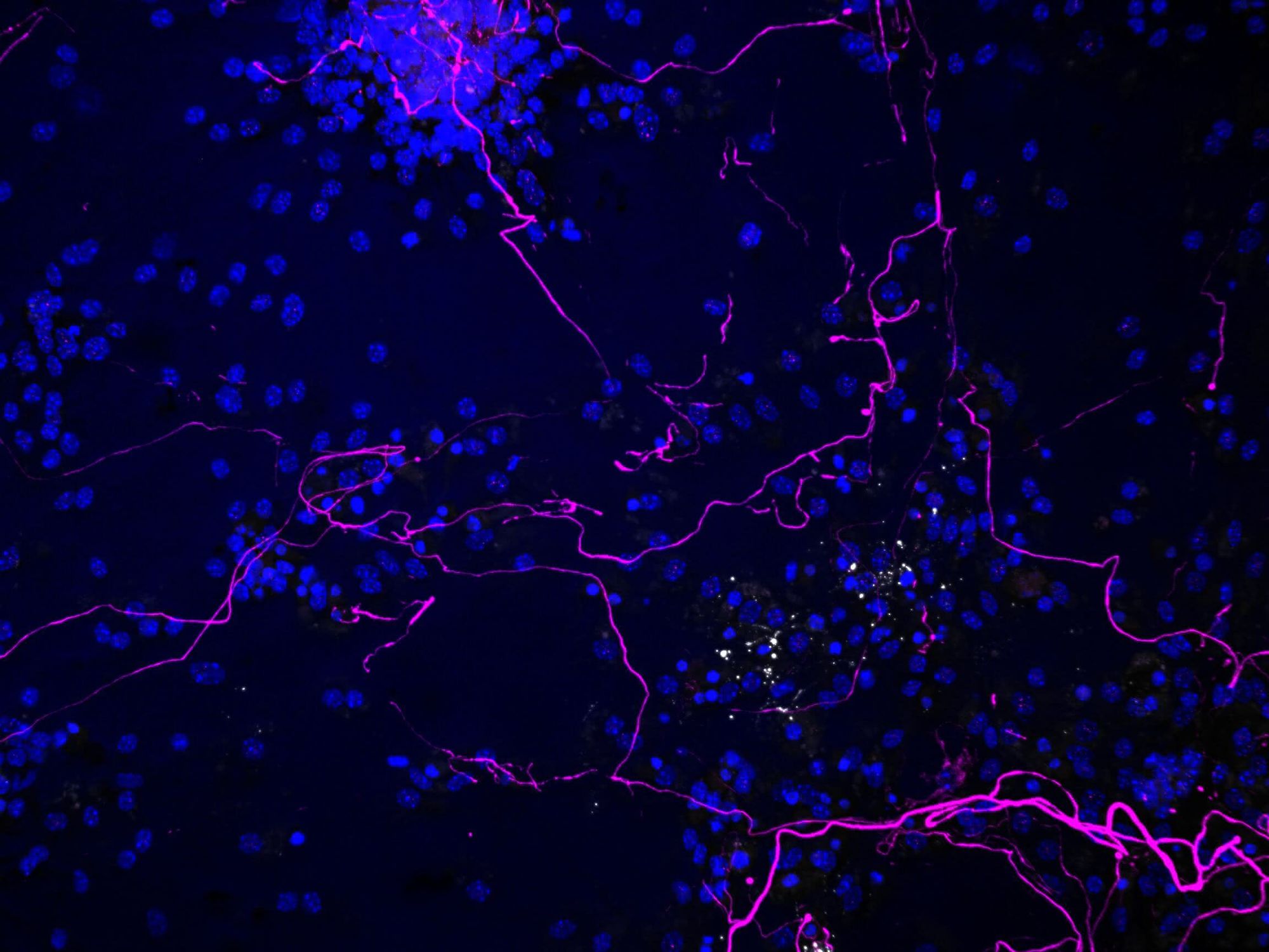 Entzündungsbotenstoff IL-12 und Alzheimer Wenn einer Zellkultur Interleukin-12 hinzugegeben wird, führt das zu einer deutlichen Reduktion der Nervenfasern (pink) und der Oligodendrozyten und damit zum Verlust von Myelin (weiß).
