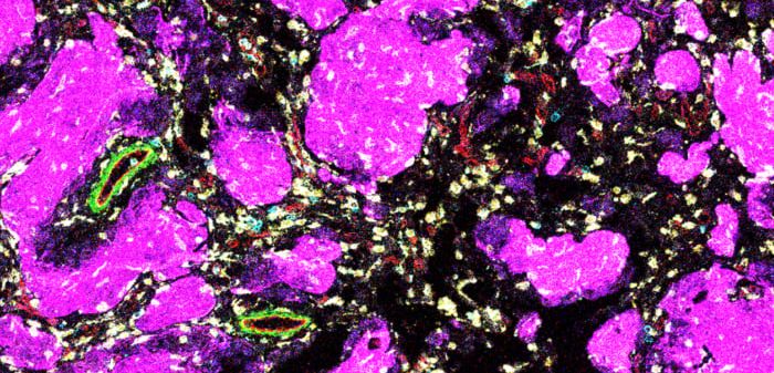 Niedrigradiges Gliom: Immunzellen der Tumorumgebung beeinflussen Therapieerfolg bei kindlichen Hirntumoren Mikroskopische Aufnahmen von Immunzellen (blau und gelb) in der zellulären Umgebung eines niedrigradigen Glioms (pink), einer häufigen Hirntumorart bei Kindern.