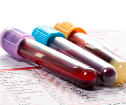 Blutuntersuchung Insulinresistenz: Biomarker des Gehirns im Blut entdeckt Blutröhrchen auf einem Labor-Anforderungsblatt