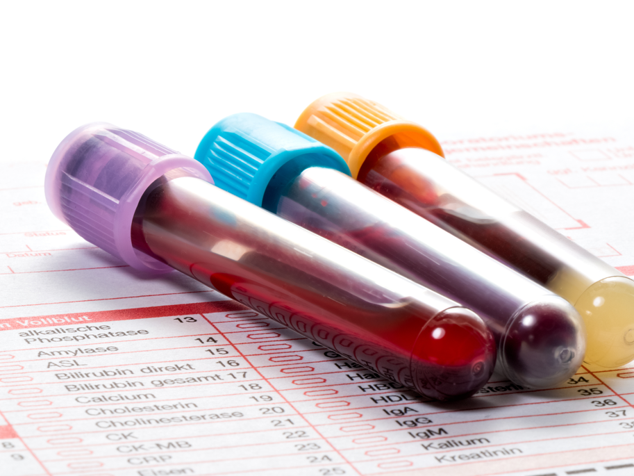 Blutuntersuchung Insulinresistenz: Biomarker des Gehirns im Blut entdeckt Blutröhrchen auf einem Labor-Anforderungsblatt