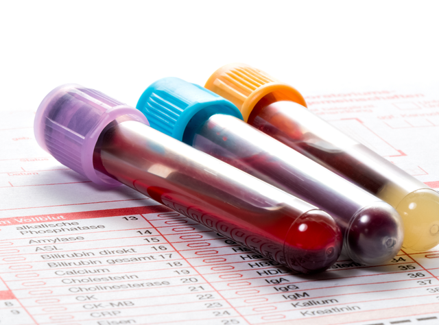 Blutuntersuchung Insulinresistenz: Biomarker des Gehirns im Blut entdeckt Blutröhrchen auf einem Labor-Anforderungsblatt