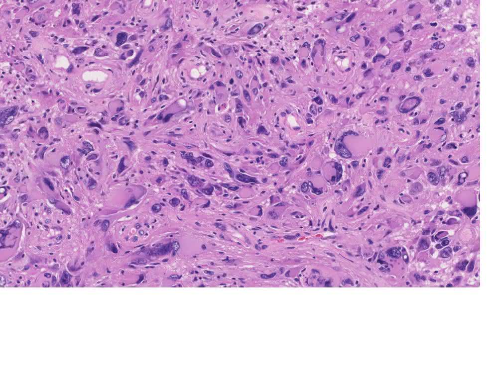 Mikroskopisches Bild eines Glioblastoms nach operativer Entfernung und Einfärbung für die neuropathologische Diagnostik.