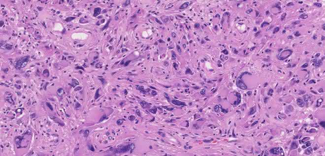 Mikroskopisches Bild eines Glioblastoms nach operativer Entfernung und Einfärbung für die neuropathologische Diagnostik. Mikroskopisches Bild eines Glioblastoms nach operativer Entfernung und Einfärbung für die neuropathologische Diagnostik.