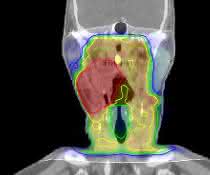 Bestrahlungsplan eines Kopf-Hals-Tumors