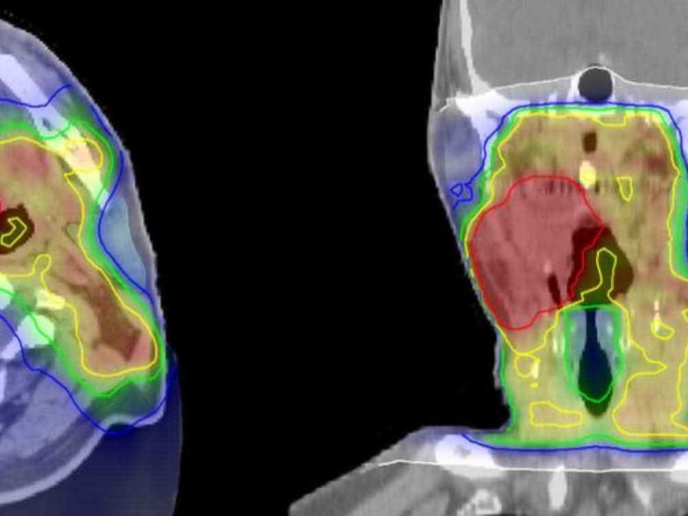 Bestrahlungsplan eines Kopf-Hals-Tumors