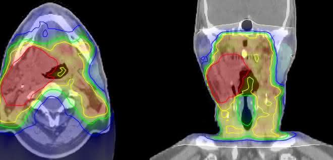 Bestrahlungsplan eines Kopf-Hals-Tumors