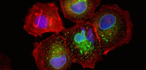 Mikroskopische Aufnahme: Brustkrebs-Zelllinie MCF7 produziert Mikroprotein CASIMO1