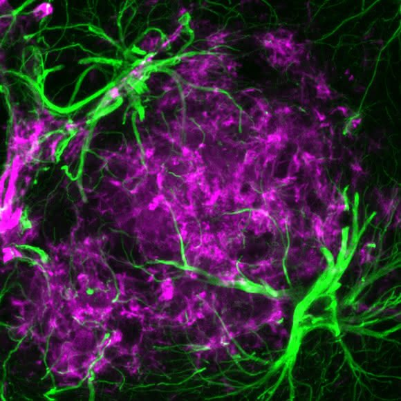 Sternförmige Astrozyten haben sich rund um krankhafte Eiweißablagerungen angesammelt. Solche „Plaques“ sind ein Merkmal der Alzheimer-Erkrankung.