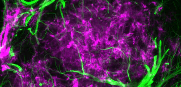 Sternförmige Astrozyten haben sich rund um krankhafte Eiweißablagerungen angesammelt. Solche „Plaques“ sind ein Merkmal der Alzheimer-Erkrankung.