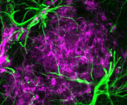 Sternförmige Astrozyten (grün) haben sich rund um krankhafte Eiweißablagerungen angesammelt (lila). Solche „Plaques“ sind ein Merkmal der Alzheimer-Erkrankung. (Bild: DZNE, Nicole Reichenbach) Sternförmige Astrozyten haben sich rund um krankhafte Eiweißablagerungen angesammelt. Solche „Plaques“ sind ein Merkmal der Alzheimer-Erkrankung.