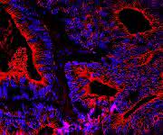 Darmkrebs unter dem Mikroskop (Bild: Lutz Langbein, DKFZ) Mikroskopische Aufnahme von Darmkrebszellen