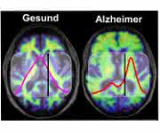 Im Gehirn von Menschen mit Alzheimer-Demenz kommt es zu krankhaften Ablagerungen des Proteins Amyloid-Beta ... Ablagerungen im Gehirn