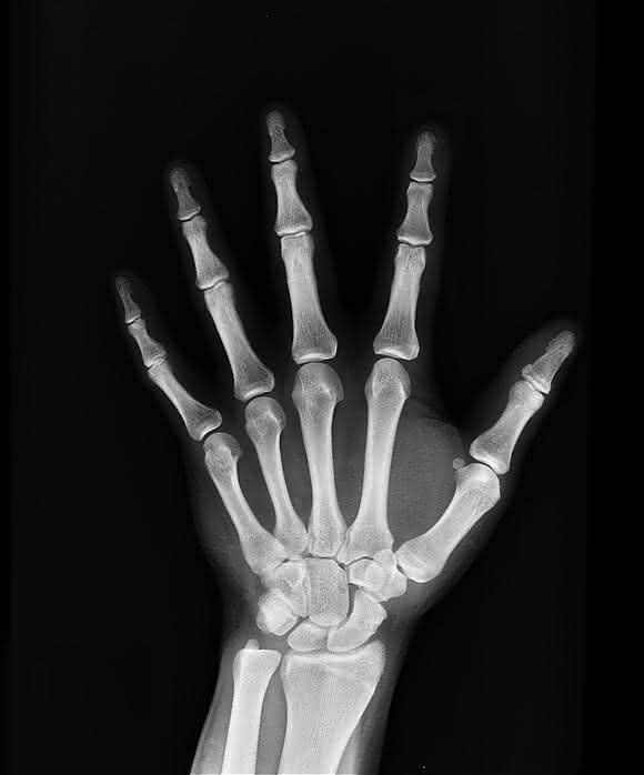 Röntgenaufnahme Hand