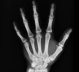 Röntgenaufnahme Hand