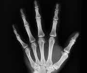 Feinheiten von Knochen untersuchen Wissenschaftler künftig in einem Speziallabor für Biomechanik ... Röntgenaufnahme Hand