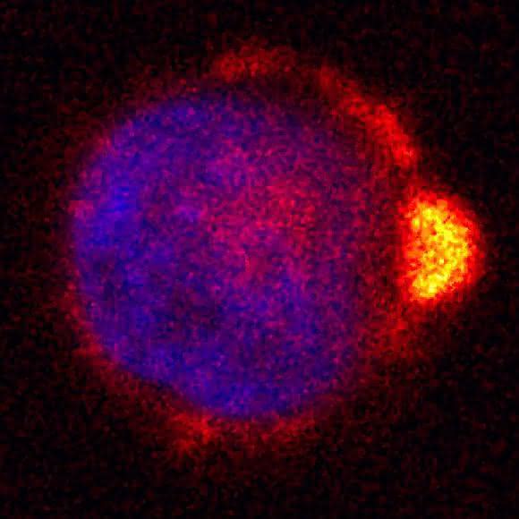 Mikroskopische Aufnahme einer Melanomzelle mit "Nase"