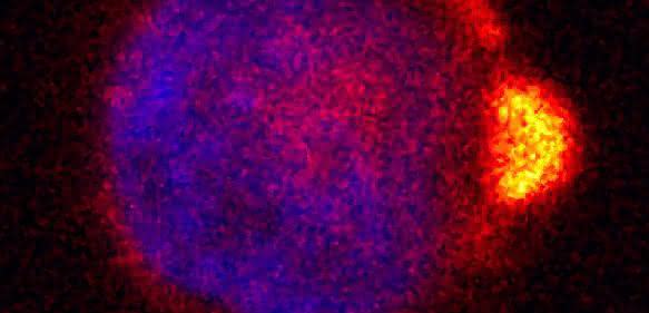 Mikroskopische Aufnahme einer Melanomzelle mit "Nase"