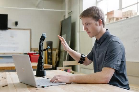 Customized 3D printed arm prostheses