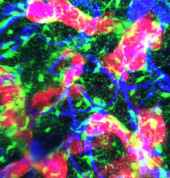 Mikroskopische Aufnahme einer wachsenden Metastase