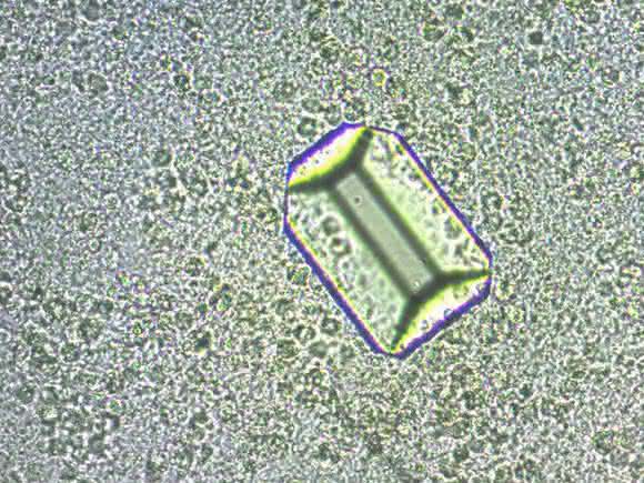 Tripelphosphat im Urin