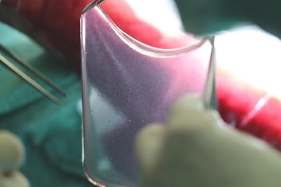 Fibrinsheet mit den darauf befindlichen genetisch modifizierten Stammzellen
