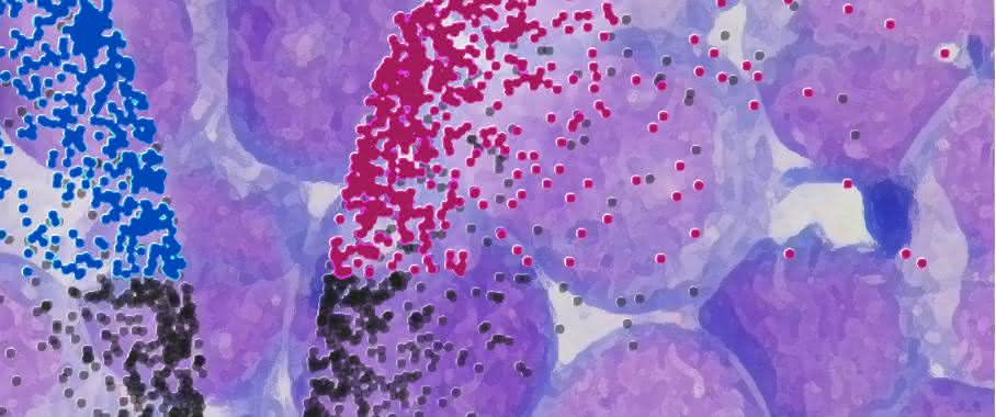 Krebsstammzellen mit einem charakteristischen Proteinexpressionsprofil lösen Blutkrebs aus. (Bild: DKFZ) Krebsstammzellen mit einem charakteristischen Proteinexpressionsprofil