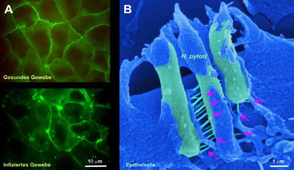 Gesundes und mit Helicobacter pylori Bakterien infiziertes Epithelzellgewebe