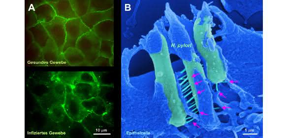 Gesundes und mit Helicobacter pylori Bakterien infiziertes Epithelzellgewebe