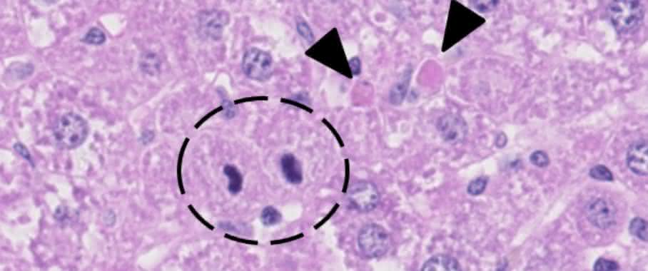 Ein Modell für chronische Lebererkrankung: Die Leberzellen der Maus sind genetisch so modifiziert, dass sie besonders häufig an Apoptose sterben. Apoptotische Zellen sind durch Pfeile gekennzeichnet, im Kreis sind teilende Zellen erkennbar. (Bild: Heikenwälder/DKFZ) Leberzellen der Maus, genetisch modifiziert