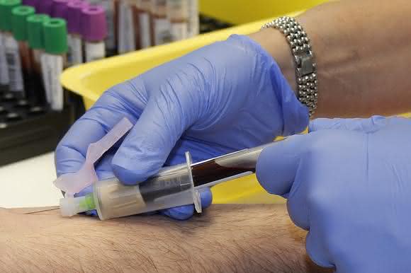 Chemotherapie - ja oder nein?: Biomarker zeigen Aggressivität des Tumors an