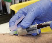 Bluttest Chemotherapie - ja oder nein?: Biomarker zeigen Aggressivität des Tumors an