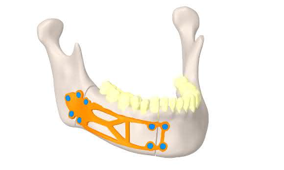 Implantat Kieferknochen