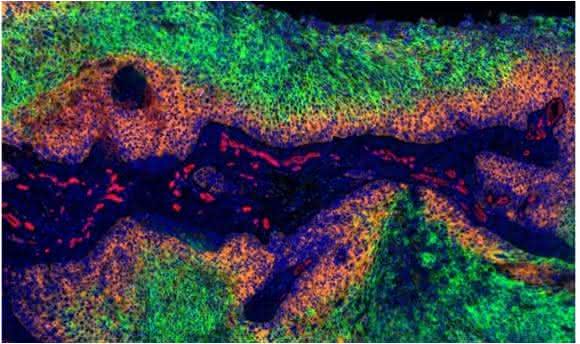 Gebärmutterhalskrebs: In den grün gefärbten Bereichen des Tumors herrscht Sauerstoffmangel. Dort bilden die Krebszellen kein HPV-E7 (orange). Zellkerne sind blau, Blutgefäße rot markiert. (© Dr. Arnulf Mayer, Universität Mainz)
