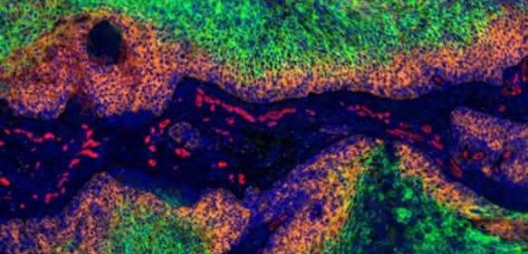 Gebärmutterhalskrebs: In den grün gefärbten Bereichen des Tumors herrscht Sauerstoffmangel. Dort bilden die Krebszellen kein HPV-E7 (orange). Zellkerne sind blau, Blutgefäße rot markiert. (© Dr. Arnulf Mayer, Universität Mainz)